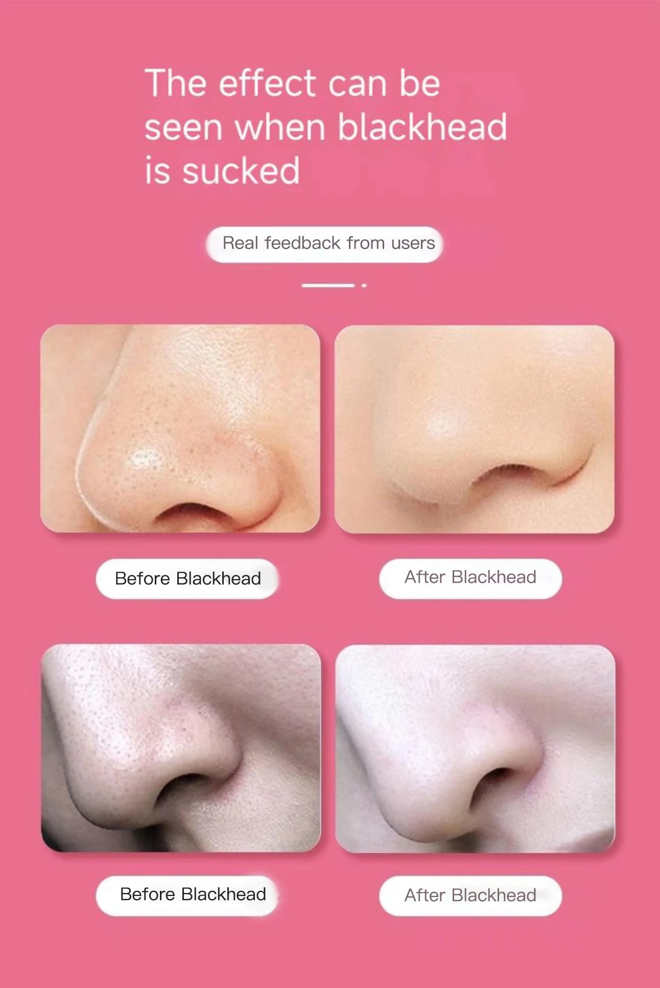 Dispositivo Elétrico de Limpeza de Poros e Acne