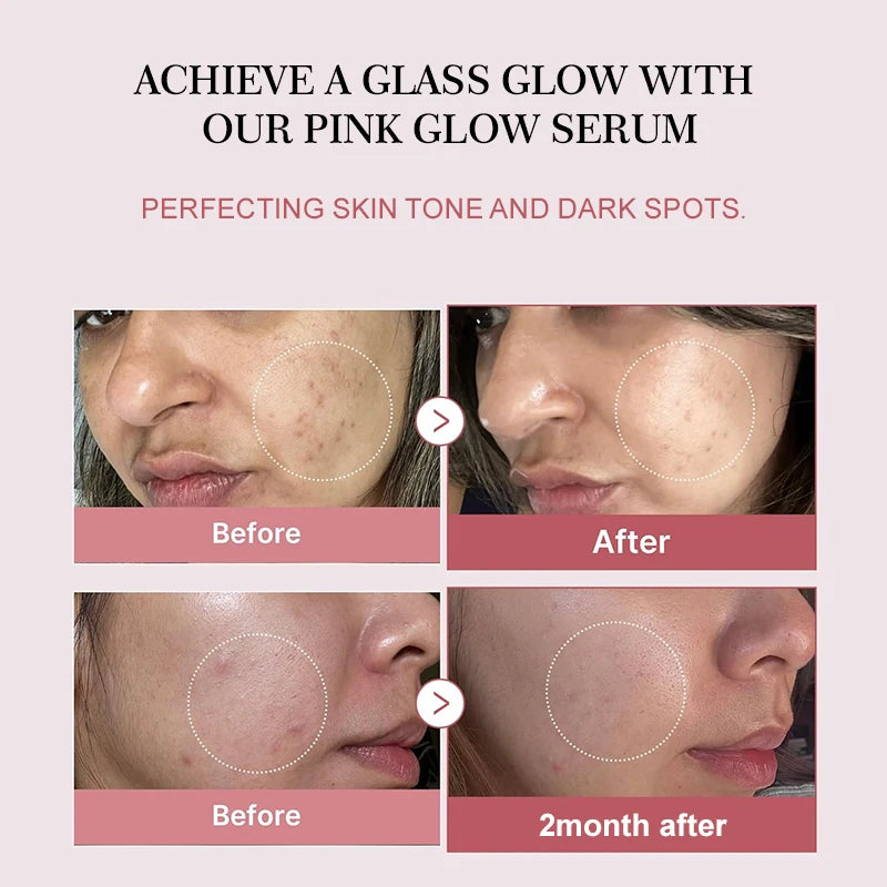 Sérum Antiacne de Peptídeo Complexo