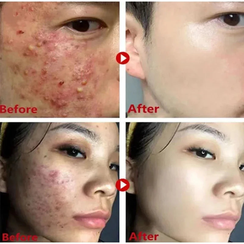 Máscara de Lama Removedora de Cravos com Chá Verde, Bastão de Limpeza Facial, Combate Espinhas e Manchas, Reduz Poros, Controle de Oleosidade, Esfolia e Clareia a Pele