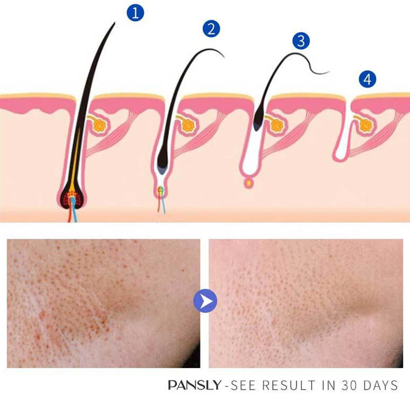 Inibidor de Remoção de Crescimento de Pelos Barba Biquíni Pernas Íntimas Corpo Axila Lotioína Suaviza a Pele e Cabelo Depilatório Indolor Permanante