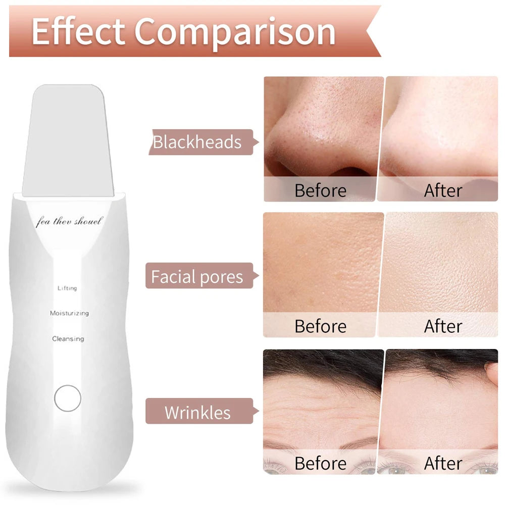 Raspador de pele ultrassônico Peeling Removedor de cravo Limpeza facial profunda Lifting Acne Pore Cleaner Espátula facial Limpador de pá