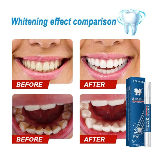 Caneta de clareamento dental Reparação Remover placa de melanina amarela 7 dias Limpeza rápida dos dentes Ferramentas de tratamento de dentes Placa de beleza Saúde