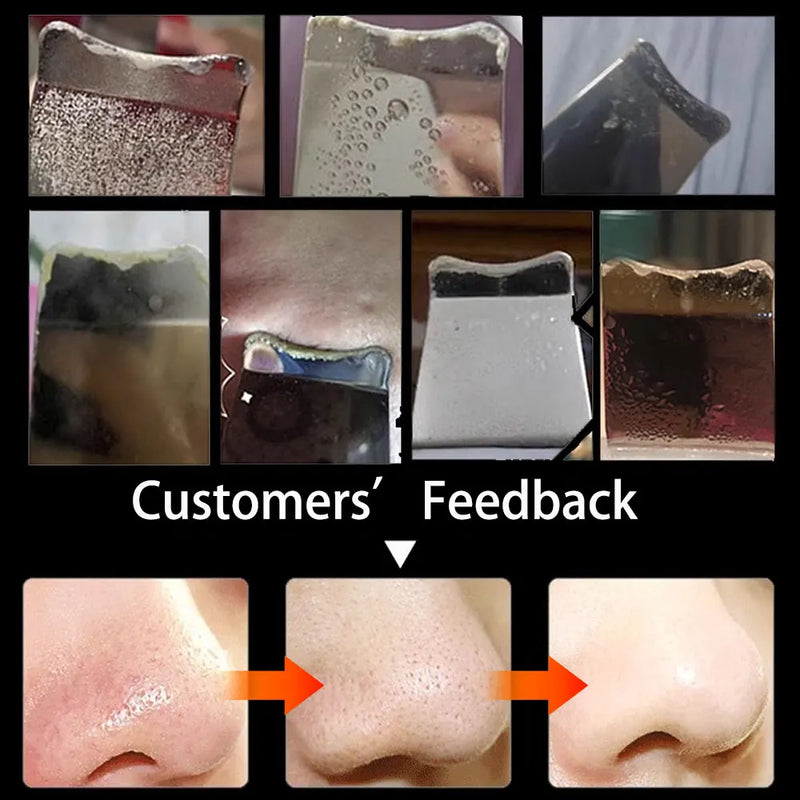 Raspador de pele ultrassônico Peeling Removedor de cravo Limpeza facial profunda Lifting Acne Pore Cleaner Espátula facial Limpador de pá