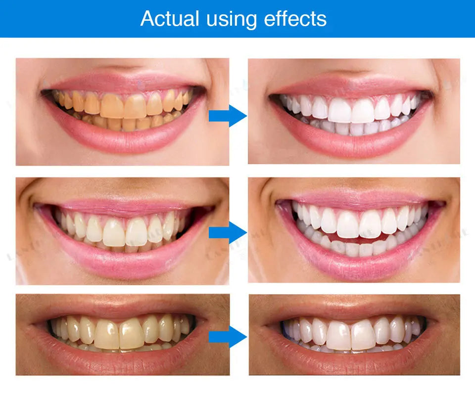 Caneta de clareamento dental Reparação Remover placa de melanina amarela 7 dias Limpeza rápida dos dentes Ferramentas de tratamento de dentes Placa de beleza Saúde