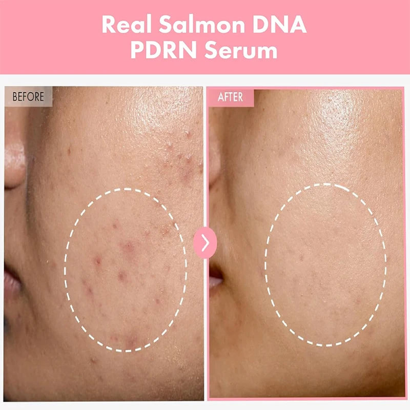 Sérum Antiacne de Peptídeo Complexo PDRN Colágeno Reduz Poros Clareia Melanina Suaviza e Ilumina a Pele Produtos Coreanos de Skincare