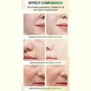 Face Care Exfoliating Radiant Skin Fade Dark Spots & Pigmentation for Even Brighter Skin Remove Spots Arm Knee Legs Melanin