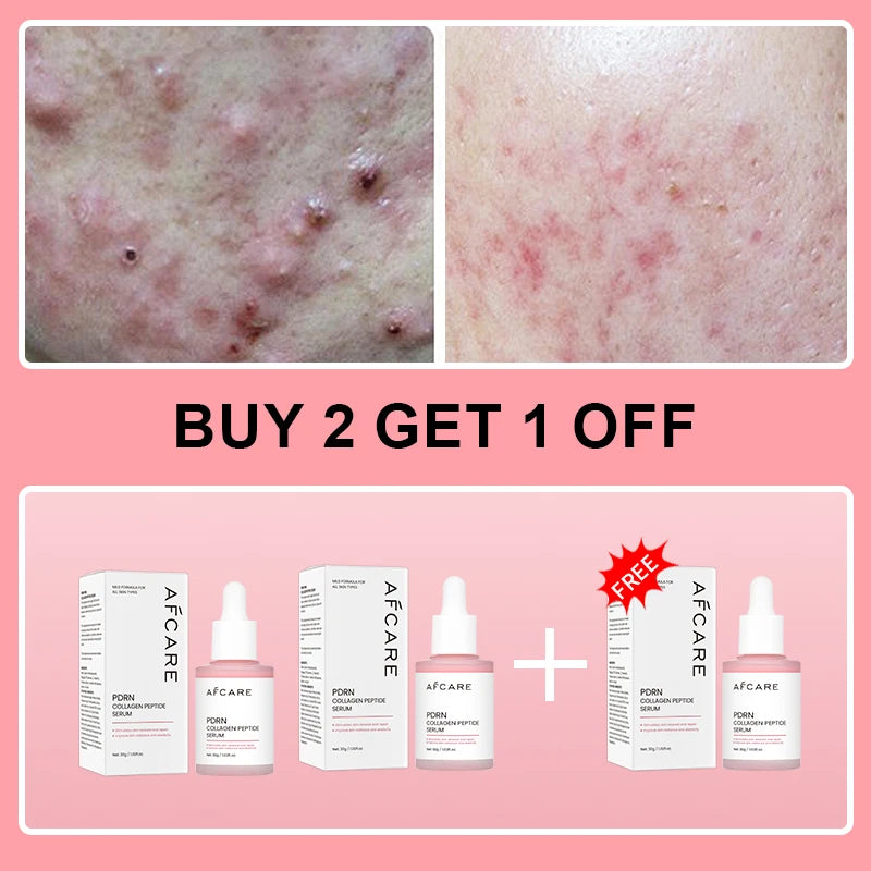 Sérum Antiacne de Peptídeo Complexo PDRN Colágeno Reduz Poros Clareia Melanina Suaviza e Ilumina a Pele Produtos Coreanos de Skincare