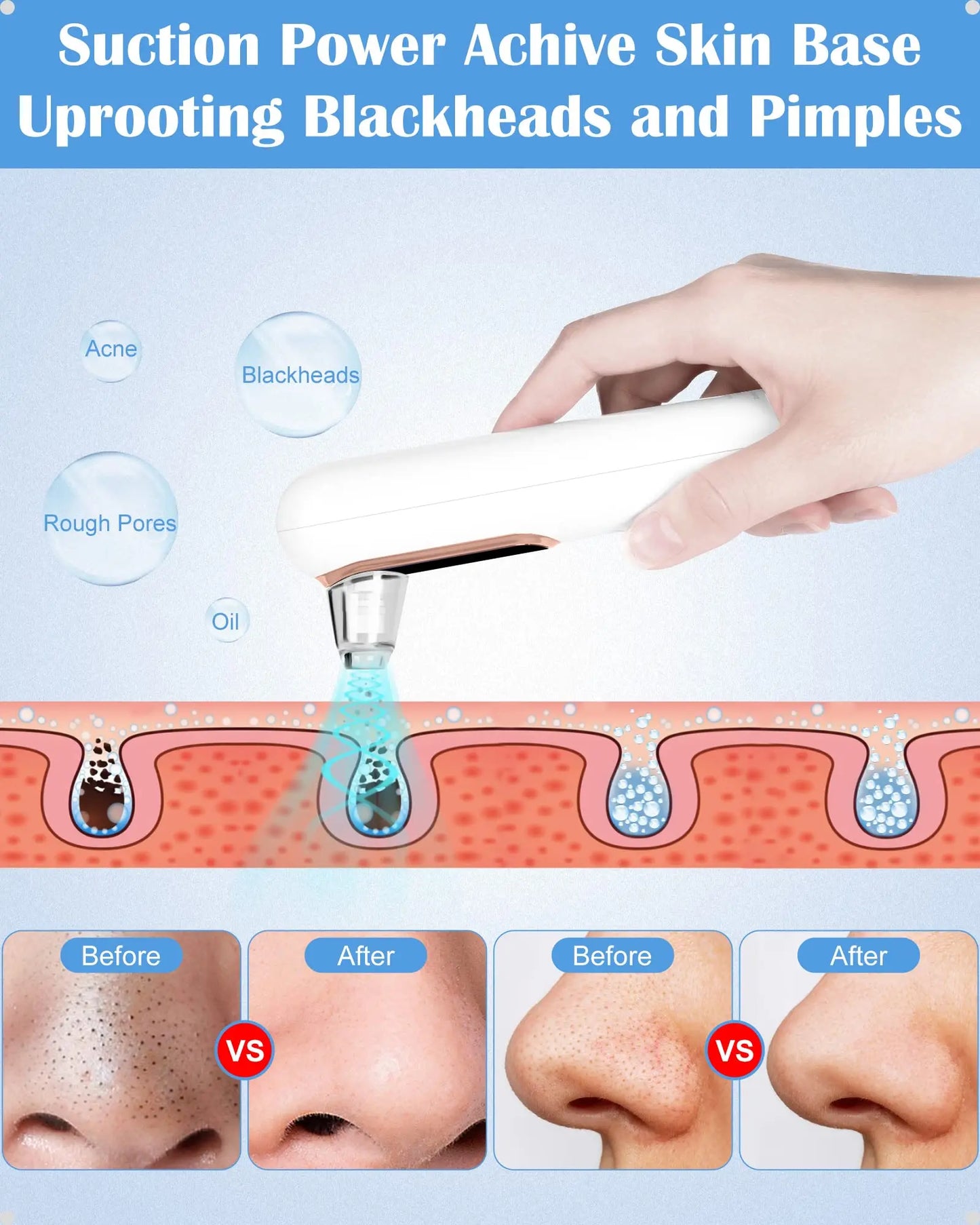 Aspirador de Cravos Limpador de Acne Remoção