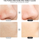 Raspador de pele ultrassônico Peeling Removedor de cravo Limpeza facial profunda Lifting Acne Pore Cleaner Espátula facial Limpador de pá