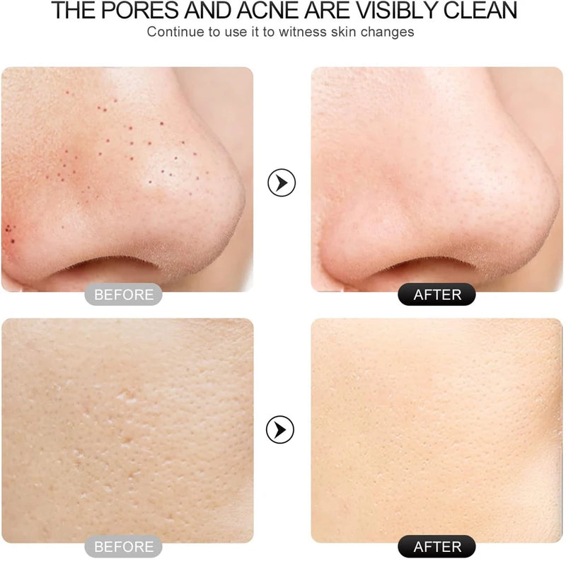 Raspador de pele ultrassônico Peeling Removedor de cravo Limpeza facial profunda Lifting Acne Pore Cleaner Espátula facial Limpador de pá